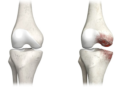 osteoartrite de joelho